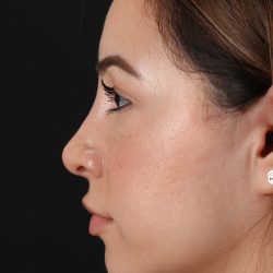 Rhinoplasty Before & After Patient #3247