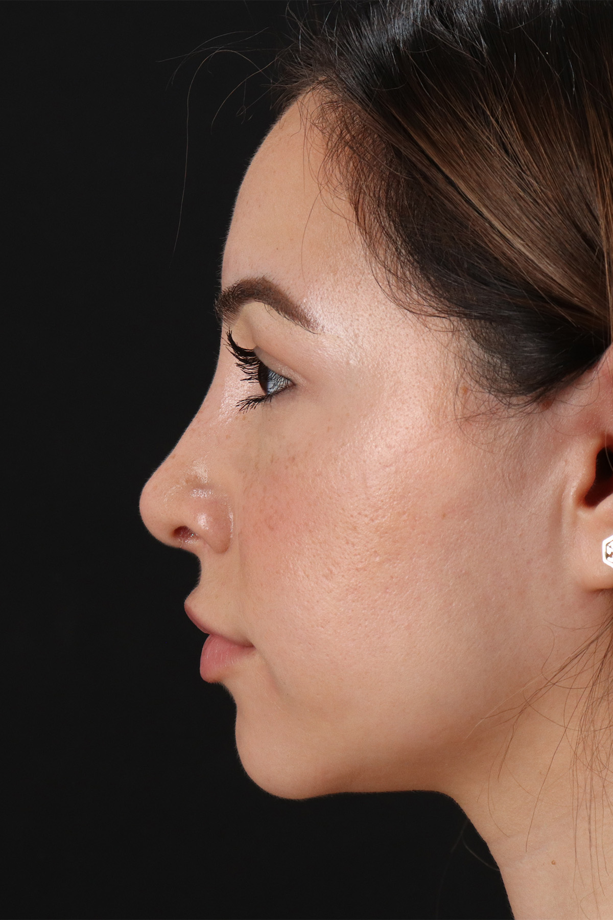 Rhinoplasty Before & After Patient #3247