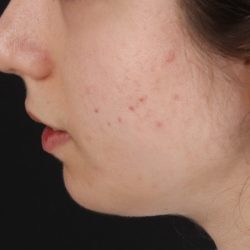 Chin Implant Before & After Patient #1551