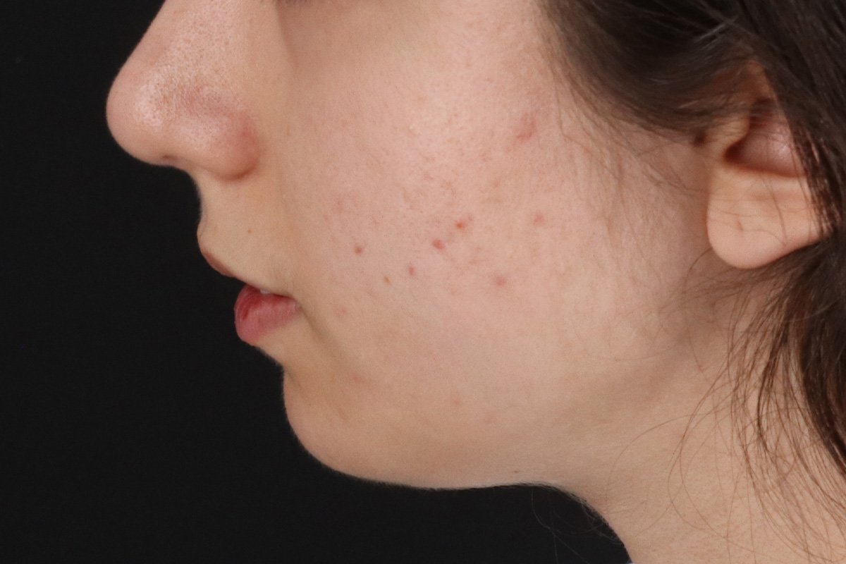 Chin Implant Before & After Patient #1551