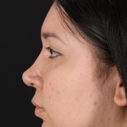 Chin Implant Before & After Patient #1604