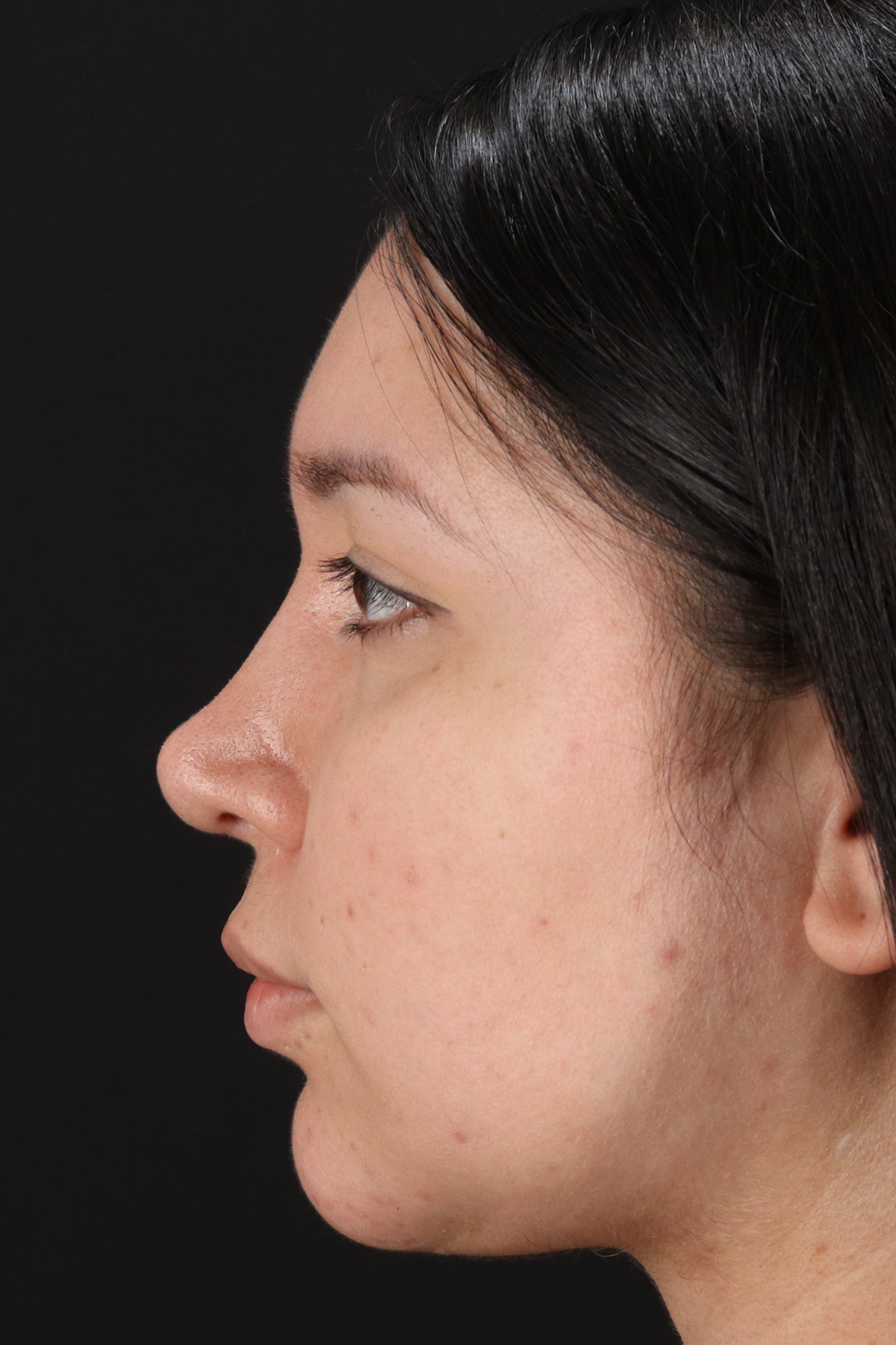 Chin Implant Before & After Patient #1604