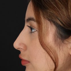 Liquid Rhinoplasty Before & After Patient #2254