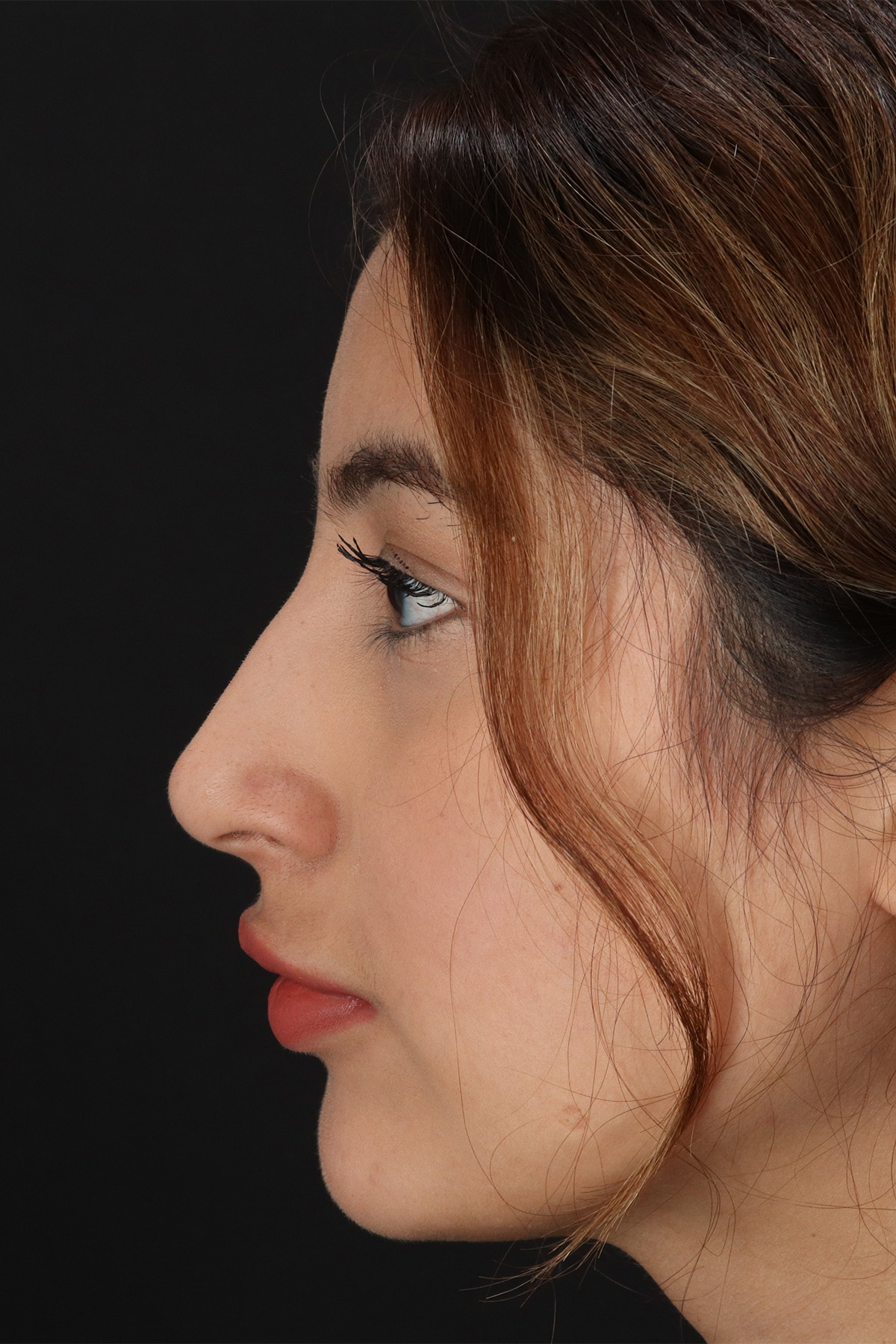 Liquid Rhinoplasty Before & After Patient #2254