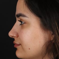 Rhinoplasty Before & After Patient #3071