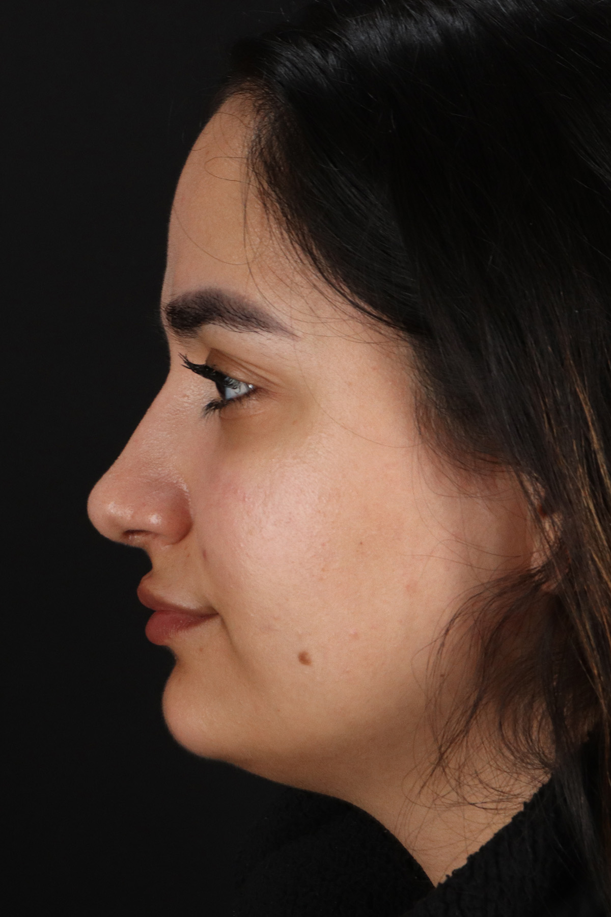 Rhinoplasty Before & After Patient #3071