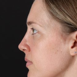 Rhinoplasty Before & After Patient #3291