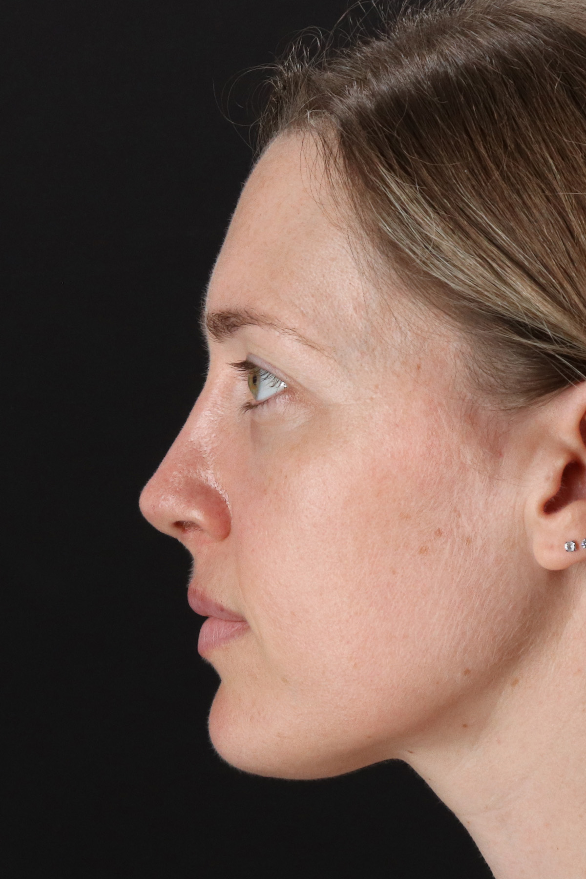 Rhinoplasty Before & After Patient #3291
