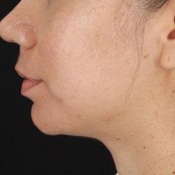 Chin Implant Before & After Patient #1540