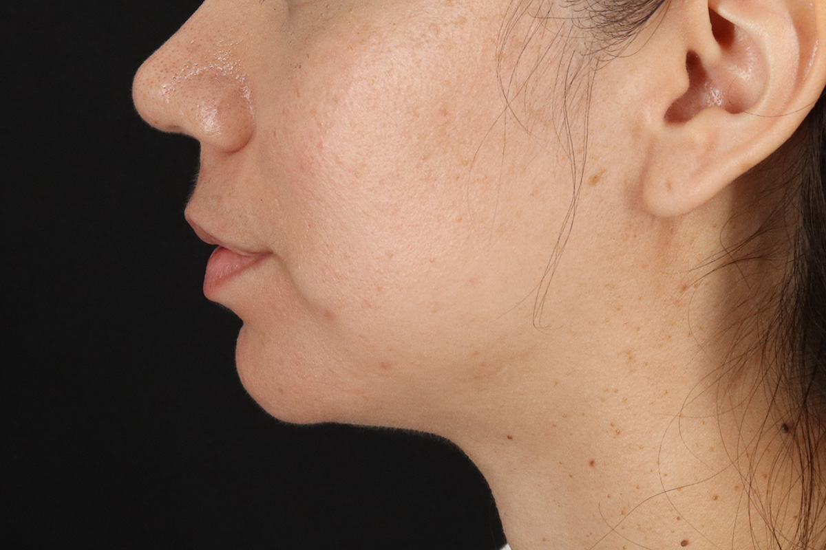 Chin Implant Before & After Patient #1540