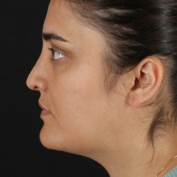 Neck Lift Before & After Patient #2560