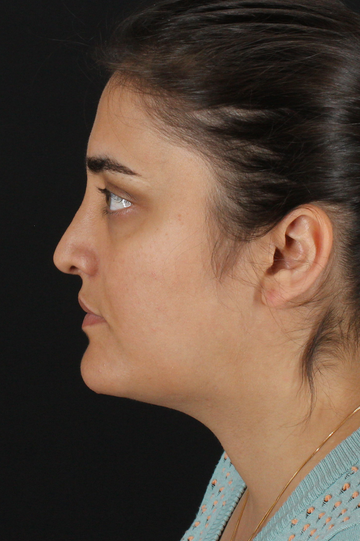 Neck Lift Before & After Patient #2560