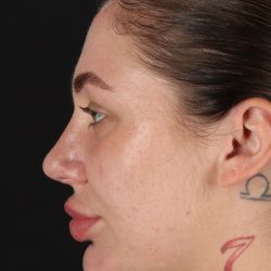 Rhinoplasty Before & After Patient #3104
