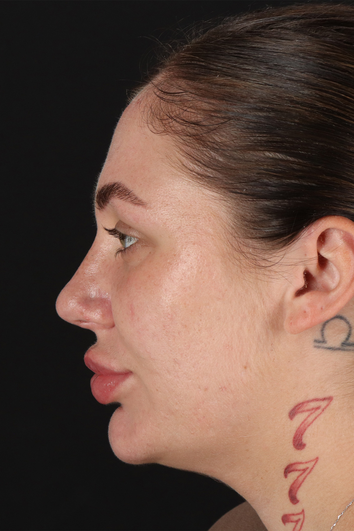 Rhinoplasty Before & After Patient #3104
