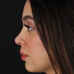 Rhinoplasty Before & After Patient #3269