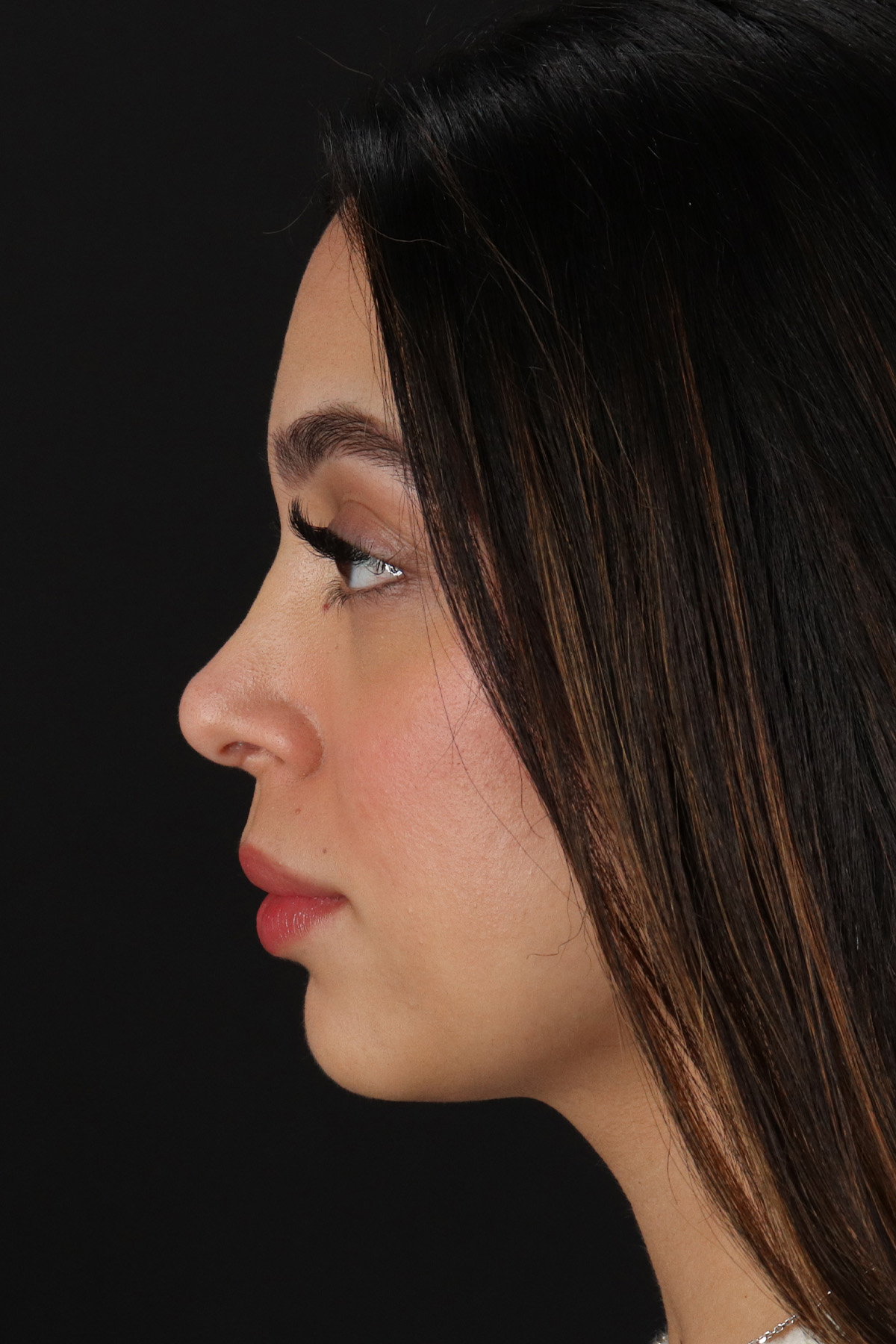 Rhinoplasty Before & After Patient #3269