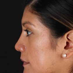 Rhinoplasty Before & After Patient #3181