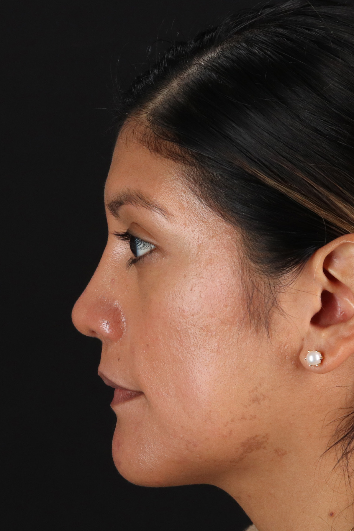 Rhinoplasty Before & After Patient #3181