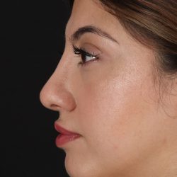 Rhinoplasty Before & After Patient #3214