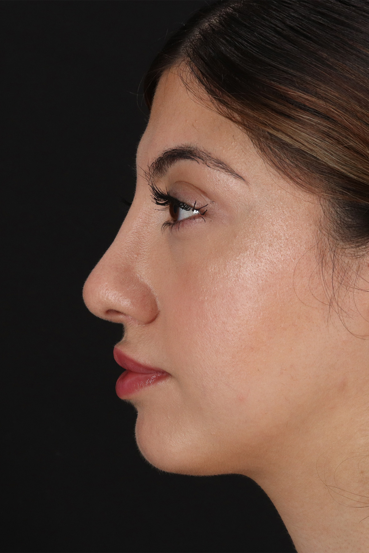 Rhinoplasty Before & After Patient #3214