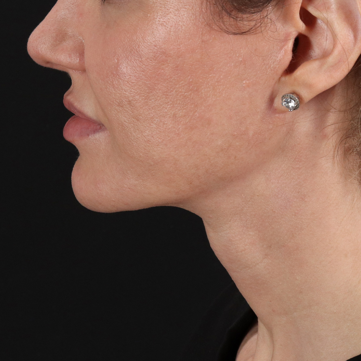 Facelift Before & After Patient #1921