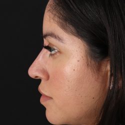 Liquid Rhinoplasty Before & After Patient #2290