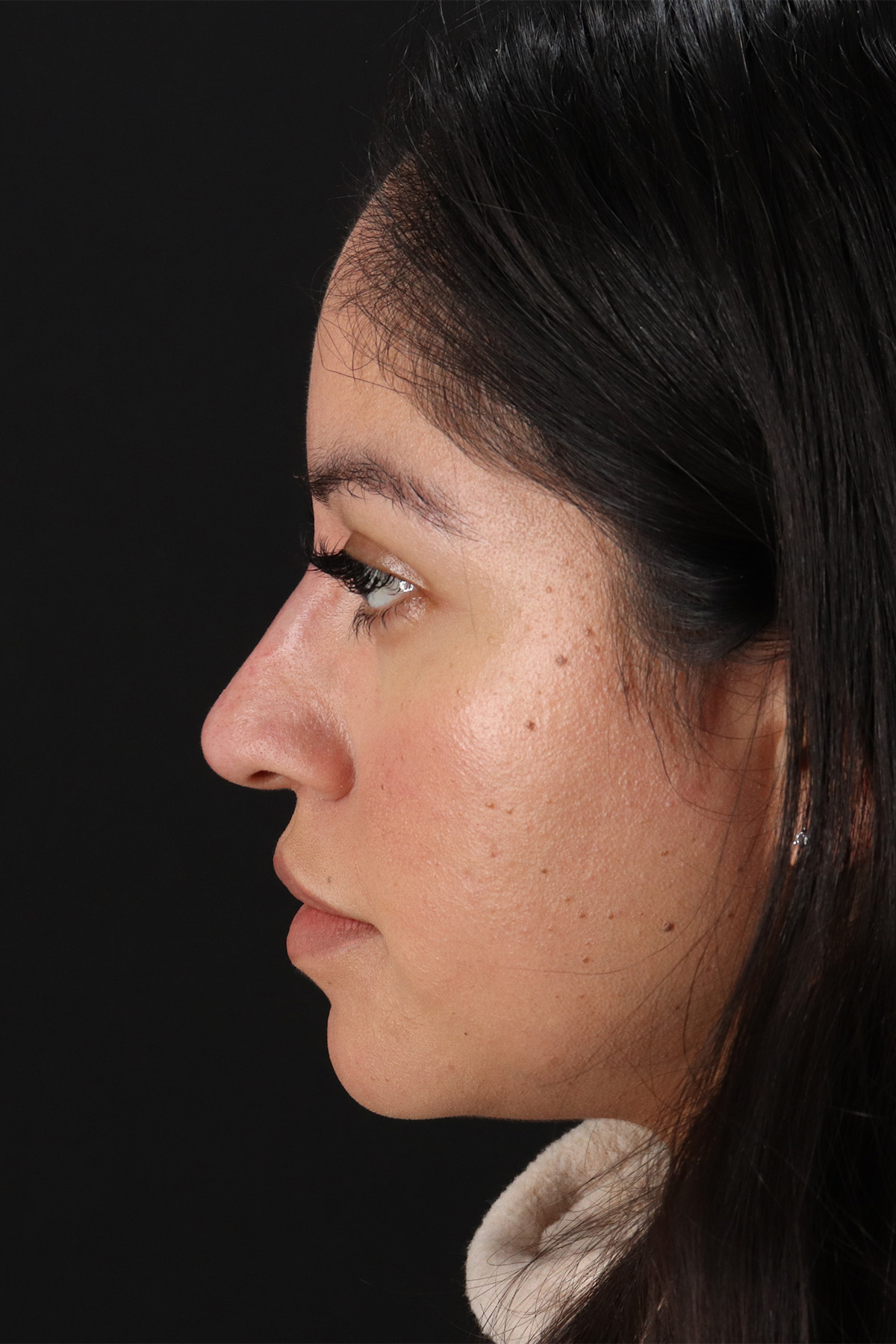 Liquid Rhinoplasty Before & After Patient #2290