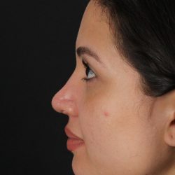 Rhinoplasty Before & After Patient #3236