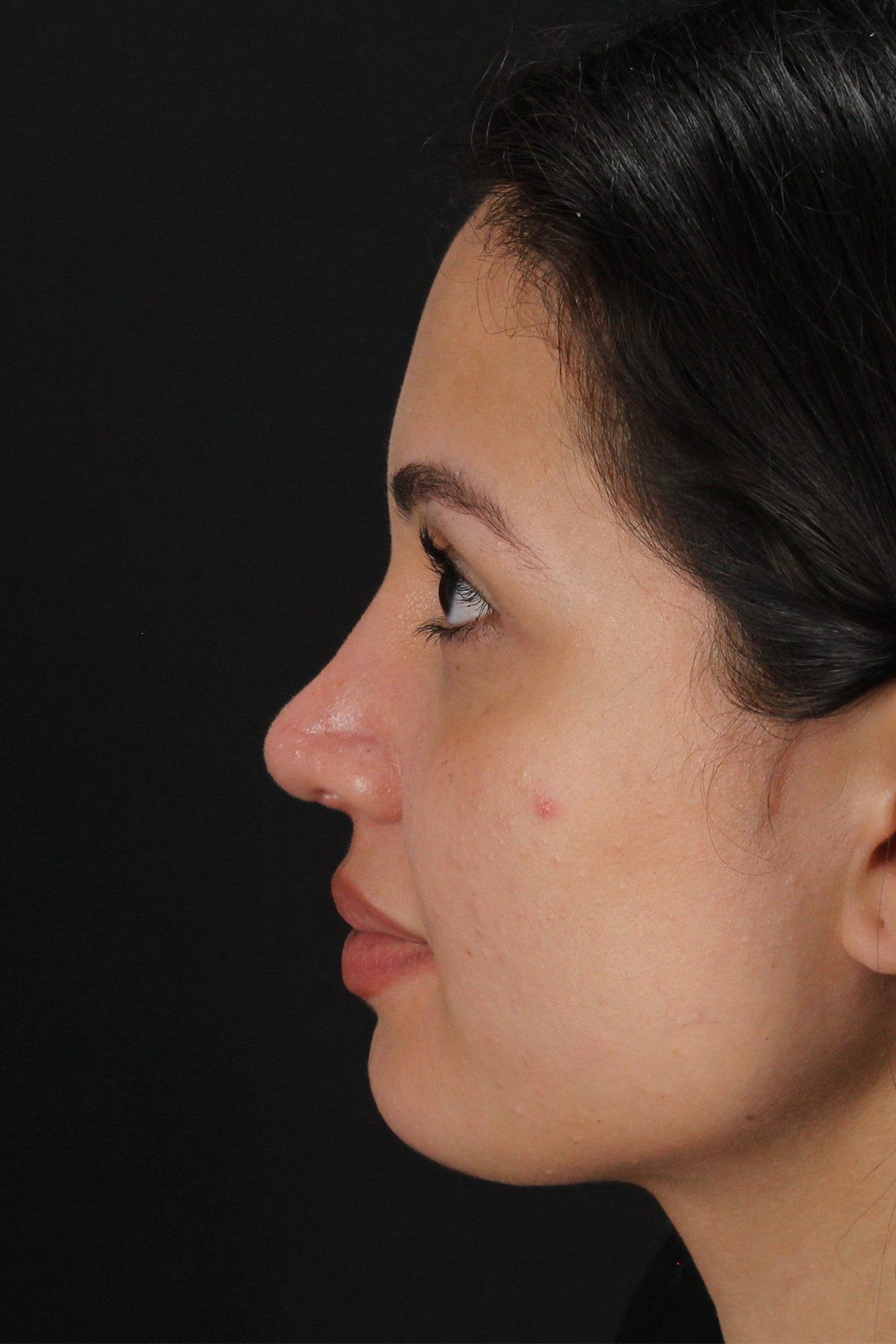 Rhinoplasty Before & After Patient #3236