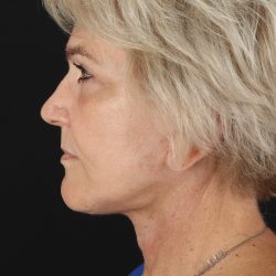 Neck Lift Before & After Patient #2648