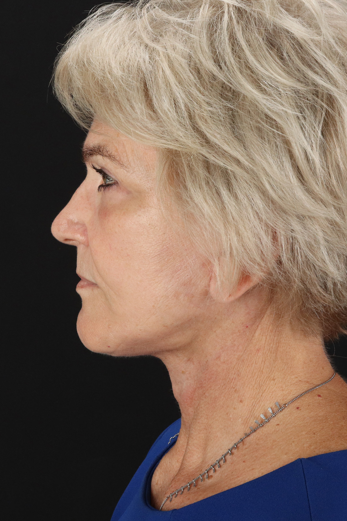 Neck Lift Before & After Patient #2648