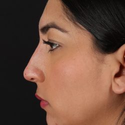 Liquid Rhinoplasty Before & After Patient #2232