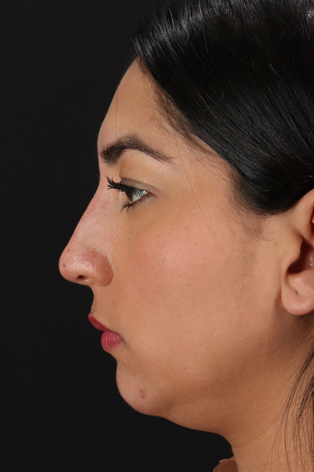 Liquid Rhinoplasty Before & After Patient #2232