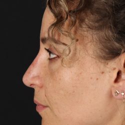 Liquid Rhinoplasty Before & After Patient #2276