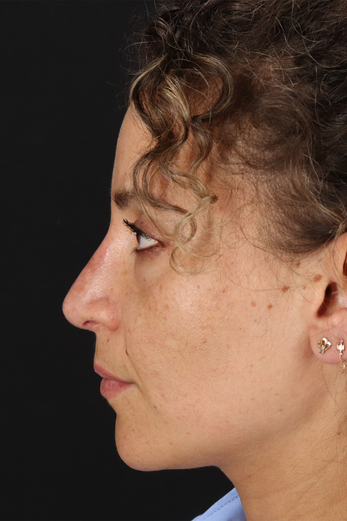Liquid Rhinoplasty Before & After Patient #2276