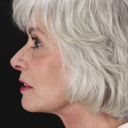 Upper Blepharoplasty Before & After Patient #5377