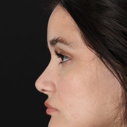 Rhinoplasty Before & After Patient #3258
