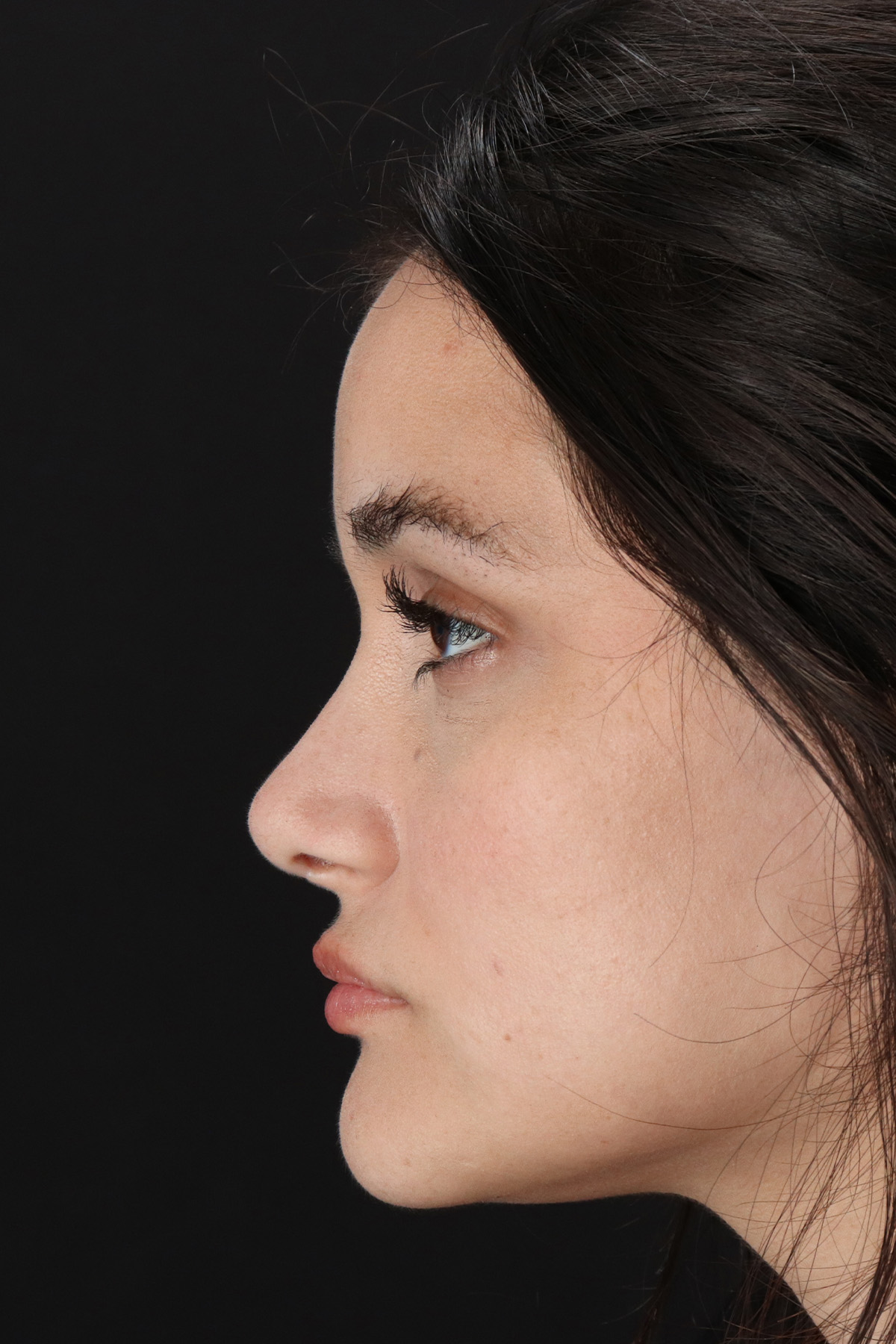 Rhinoplasty Before & After Patient #3258