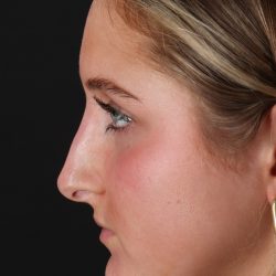 Liquid Rhinoplasty Before & After Patient #2221