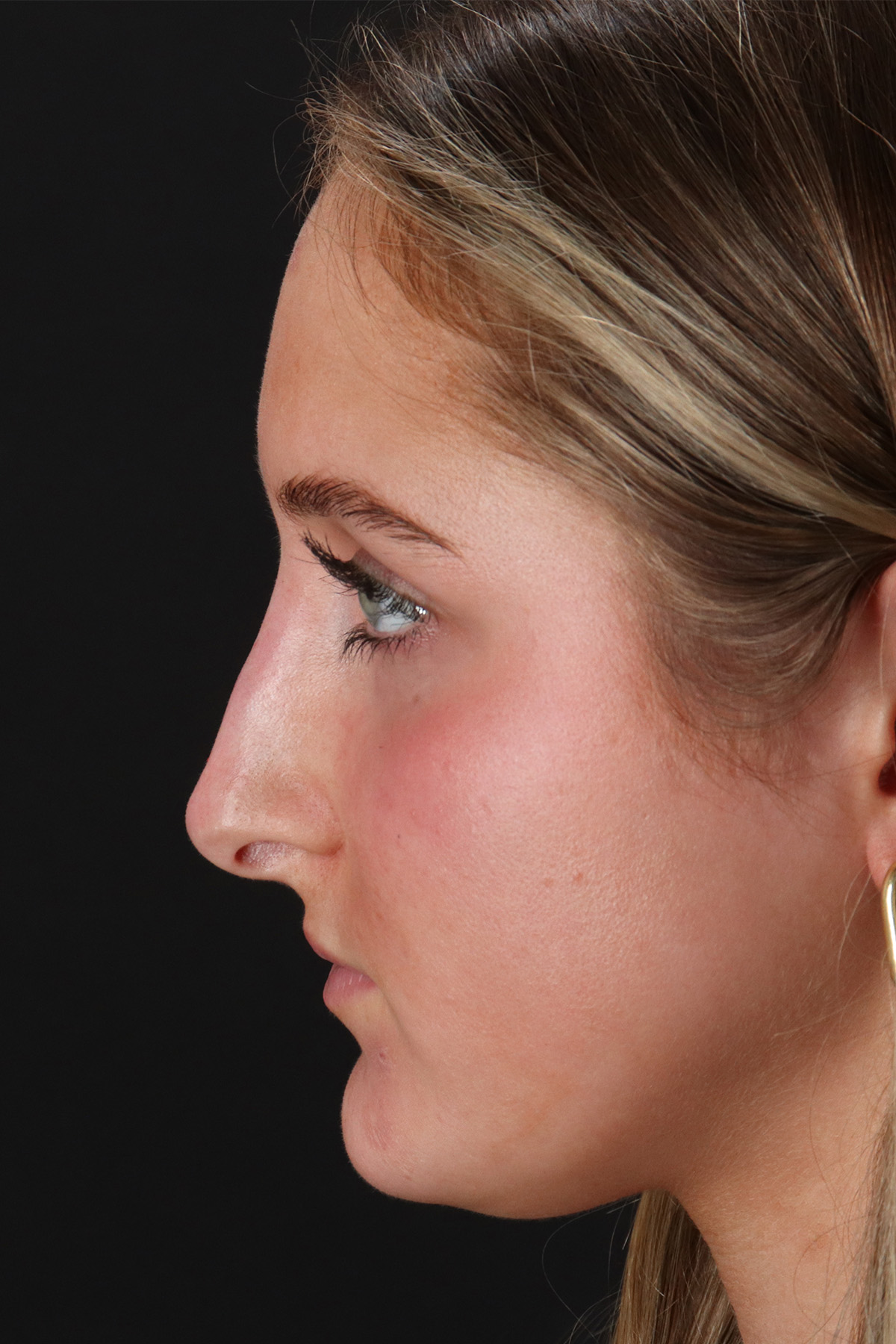 Liquid Rhinoplasty Before & After Patient #2221