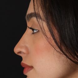 Chin Implant Before & After Patient #1637