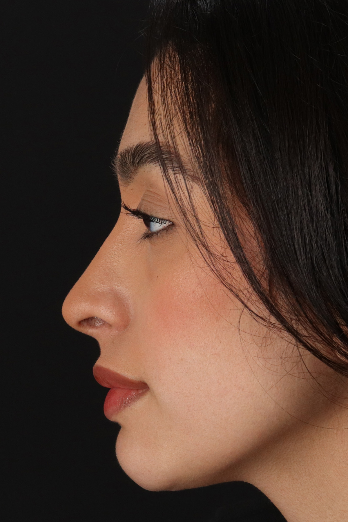 Chin Implant Before & After Patient #1637