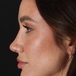 Rhinoplasty Before & After Patient #3137