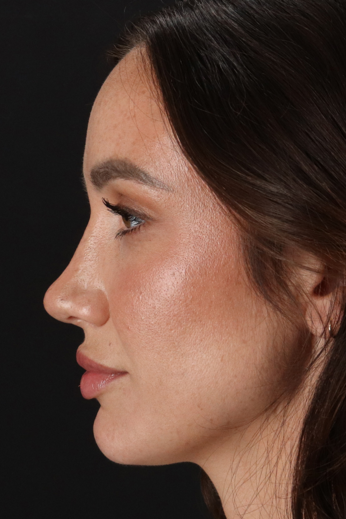 Rhinoplasty Before & After Patient #3137