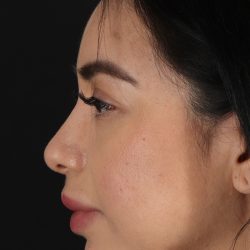 Chin Implant Before & After Patient #1626