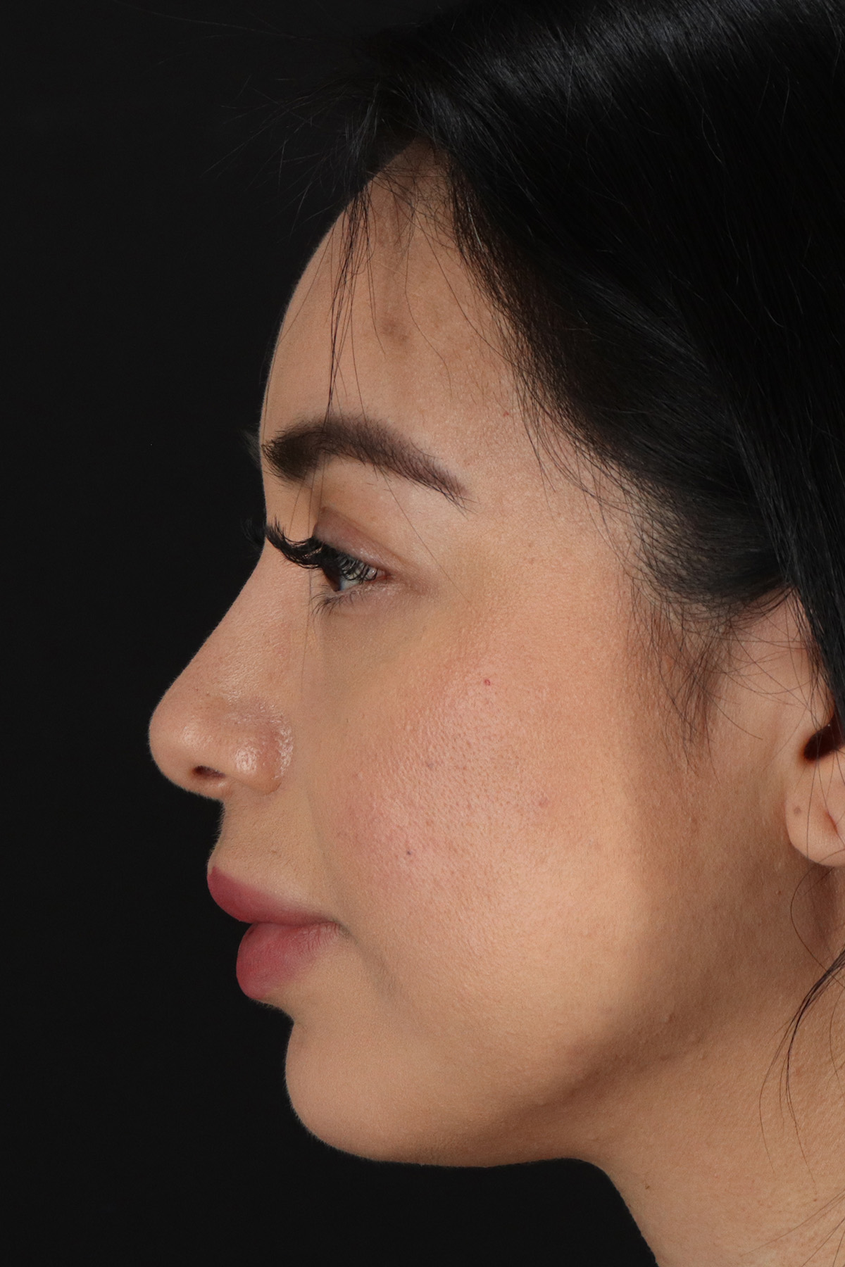 Chin Implant Before & After Patient #1626