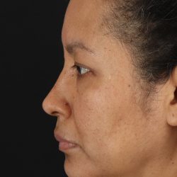 Rhinoplasty Before & After Patient #3225