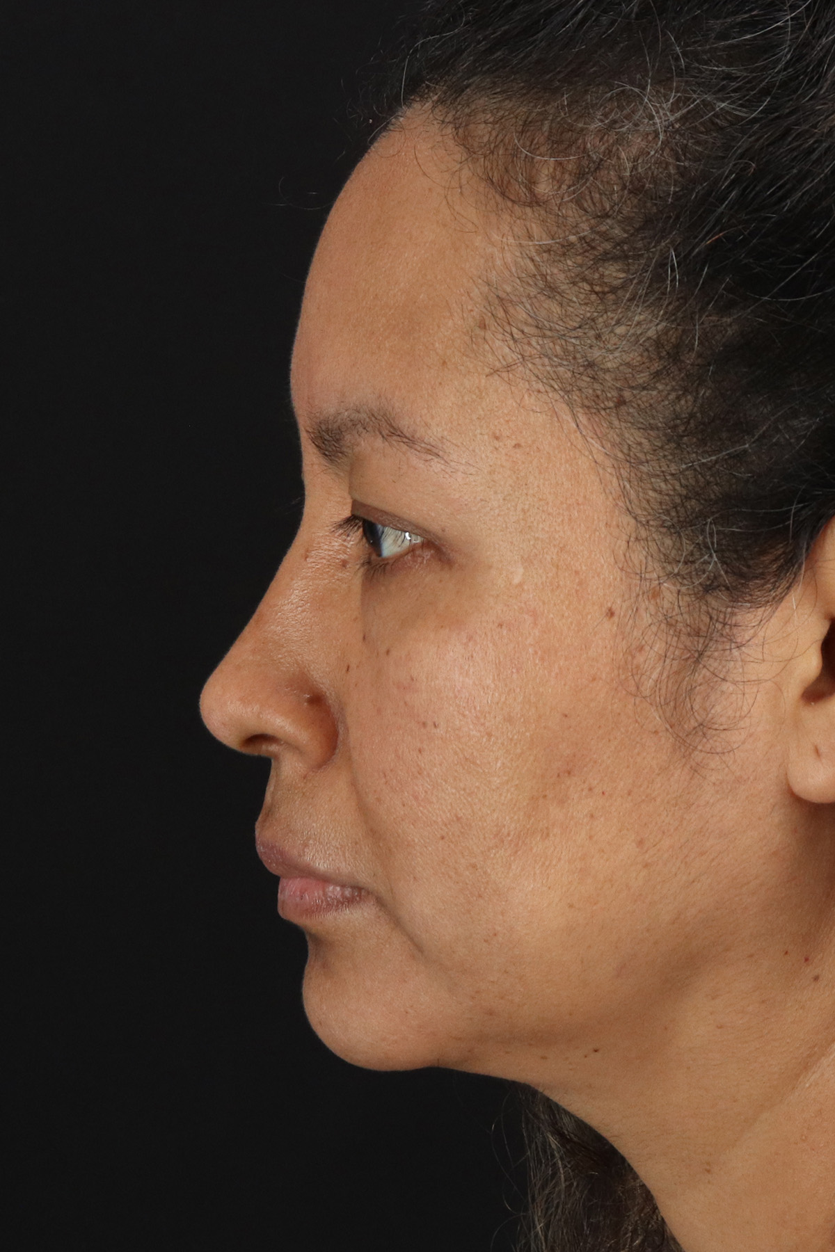 Rhinoplasty Before & After Patient #3225
