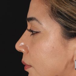 Rhinoplasty Before & After Patient #3082
