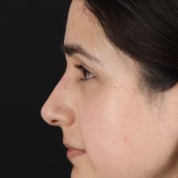 Liquid Rhinoplasty Before & After Patient #2188